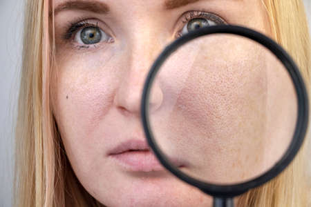 Enlarged pores, black spots, acne, rosacea close-up on the cheek. A woman is being examined by a doctor. Dermatologist examines the skin through a magnifier, a magnifying glassの素材 [FY310137276729]