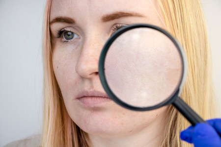 Enlarged pores, black spots, acne, rosacea close-up on the cheek. A woman is being examined by a...