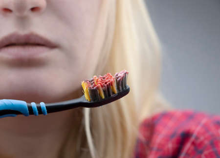 Toothbrush with blood closeup. A woman discovered bleeding gums while brushing her teeth. Gingivitis...
