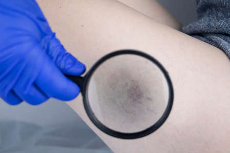 A vascular surgeon examines a leg with varicose veins. Vascular network and blood vessels are shown close-up through a magnifying glass. Preparation for laser treatment and sclerotherapyの写真素材