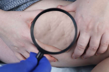 A doctor examines a patientâ€™s leg with lipodystrophy. A magnifying glass shows cellulite. The...