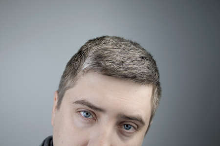 A trichologist examines a young manâs gray hair under a magnifying glass. Earlier bleaching of hair and pigment as a sign of low melanin in a guyâs bodyの写真素材