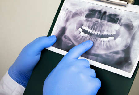 A dentist doctor examines a radiography of the teeth of a patient who has problems and teeth are inserted. The concept of research and diagnosisの写真素材