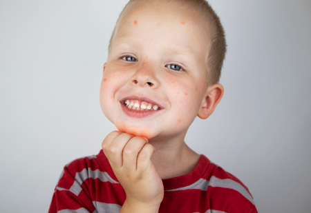 An allergist doctor makes a skin test for allergies. The boy is being examined in the laboratory,...
