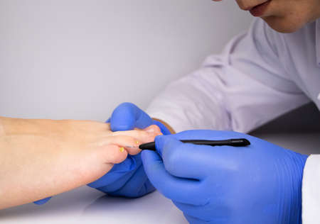 A dermatologist examines a toenail affected by a fungus. Treatment of mycosis and assistance to patients with fungal diseases.の写真素材