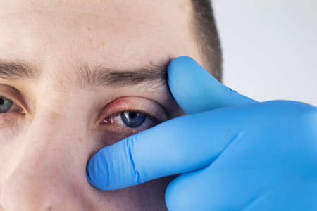 A man stands in front of a mirror and sees inflammation of the upper eyelid. Redness of the skin around the eyes and blepharitis.の写真素材