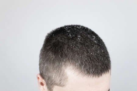 Dandruff before and after. The man on the left shows his shoulder, which has a lot of dandruff. In...