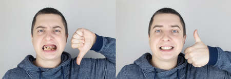 Before and after. The man shows the damaged teeth by caries, and in the second picture the dentist's work on the restoration of teeth. Children's caries, treatment, recoveryの写真素材