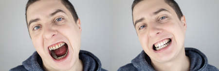 Before and after. The man shows the damaged teeth by caries, and in the second picture the dentist's work on the restoration of teeth. Children's caries, treatment, recoveryの写真素材