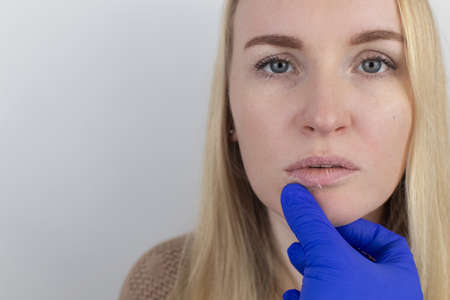 A woman examines dry skin on her lips. Peeling, coarsening, discomfort, skin sensitivity. Patient at the appointment of a dermatologist or cosmetologist. Close-up of pieces of dry skinの写真素材