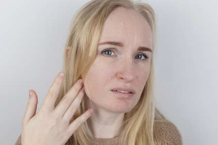 A woman examines dry skin on her face. Peeling, coarsening, discomfort, skin sensitivity. Patient at the appointment of a dermatologist or cosmetologist. Close-up of pieces of dry skinの写真素材