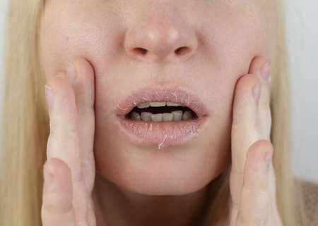 A woman examines dry skin on her lips. Peeling, coarsening, discomfort, skin sensitivity. Patient at the appointment of a dermatologist or cosmetologist. Close-up of pieces of dry skinの写真素材