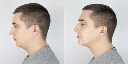 Double chin lift. Before and after plastic surgery, mentoplasty or face-building. Chin fat removal...