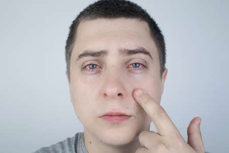 Close up of two annoyed red blood eyes of male affected by conjunctivitis or after flu, cold, allergy. Copy space for advertisement. Tired eyes after working at the computer. Close-up videos and macroの写真素材