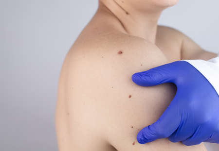 A man at a dermatologist appointment shows his birthmarks, moles and nevi. The doctor examines the patient with a dermatoscope. Benign and malignant birthmarks. Skin abnormalities care conceptの写真素材