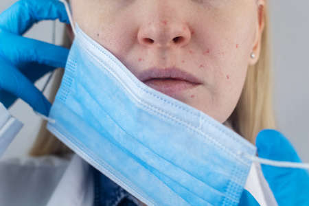 Doctor removes the protective mask and shows irritation on face skin. Antiviral measures. Means of protectionの写真素材