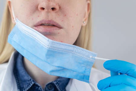 Doctor removes the protective mask and shows irritation on face skin. Antiviral measures. Means of protectionの写真素材
