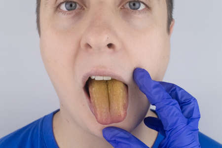 The man has a yellow tongue. Painful yellow coating on the mucous membrane of the tongue. Diseases of the gastrointestinal tract, liver and gallbladder. The consequences of taking antibiotics.の写真素材
