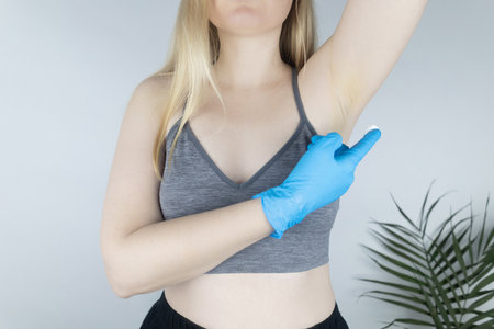 Girl in a blue medical glove smears a cream with botulinum toxin under her armpit. Novelty in cosmetology and medicine. Replacement of injection therapy. Painless treatment for excessive sweating.の写真素材
