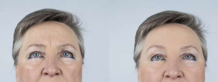 Forehead wrinkle. Photos before and after mesotherapy, biorevitalization, botulinum toxin injections. Skin fold between eyebrows. Decreased skin tone. At the appointment with a plastic surgeon or cosmetologistの写真素材