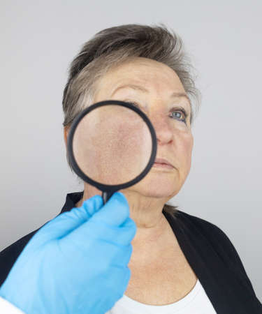Rosacea on the skin of an old woman. Close-up of a capillary network. Redness on the skin. Problems...