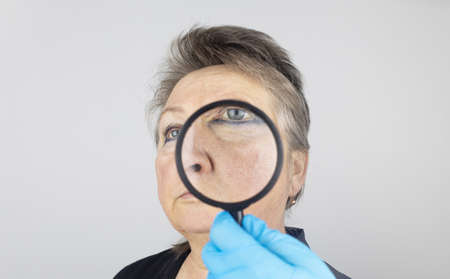 Rosacea on the skin of an old woman. Close-up of a capillary network. Redness on the skin. Problems with the outflow of blood in the capillaries. Doctor examines the problems of the patientの写真素材
