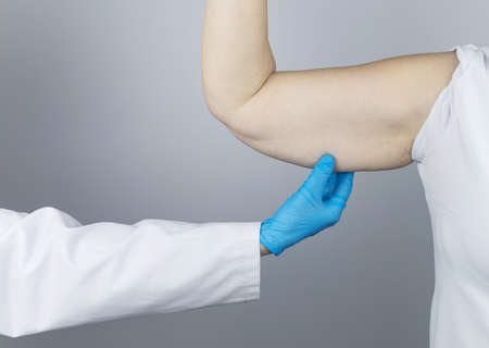 Brachioplasty. Plastic arms, dangling skin at the elbow. An older woman shows the surgeon problem areas of the forearm. Examination before cosmetic surgeryの写真素材