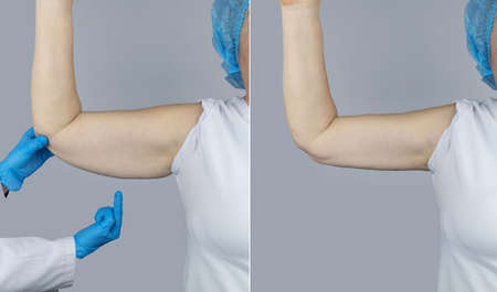 before and after. Brachioplasty. Plastic arms, dangling skin at the elbow. An older woman shows the surgeon problem areas of the forearm. Examination before cosmetic surgeryの写真素材