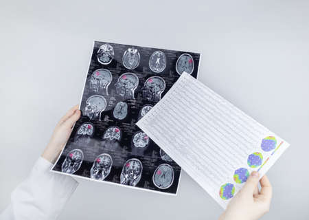 Epileptologist examines patient MRI and electroencephalogram. Concept treating epilepsy and helping people who suffer from this disease. Neurologist at work. Pathology of the brain. Seizure activityの写真素材