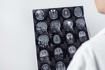 Epileptologist examines patient MRI and electroencephalogram. Concept treating epilepsy and helping people who suffer from this disease. Neurologist at work. Pathology of the brain. Seizure activityの写真素材