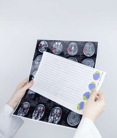 Epileptologist examines patient MRI and electroencephalogram. Concept treating epilepsy and helping people who suffer from this disease. Neurologist at work. Pathology of the brain. Seizure activityの写真素材