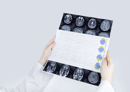 Epileptologist examines patient MRI and electroencephalogram. Concept treating epilepsy and helping people who suffer from this disease. Neurologist at work. Pathology of the brain. Seizure activityの写真素材