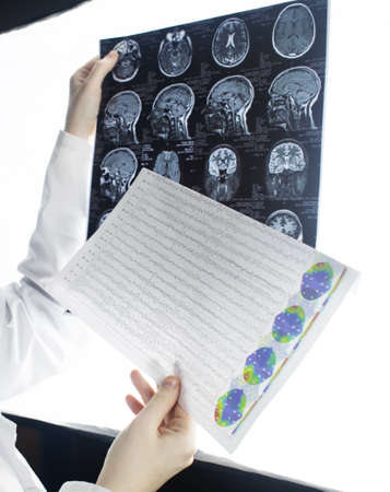 Epileptologist examines patient MRI and electroencephalogram. Concept treating epilepsy and helping people who suffer from this disease. Neurologist at work. Pathology of the brain. Seizure activityの写真素材
