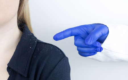 Dandruff on a blond woman shoulder. Side view of a female who has more dandruff flakes on his black shirt. Scalp disease treatment concept. Discomfort from a fungal infection. head fungusの写真素材