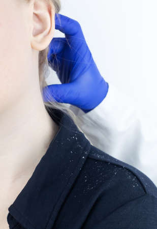 Dandruff on a blond woman shoulder. Side view of a female who has more dandruff flakes on his black shirt. Scalp disease treatment concept. Discomfort from a fungal infection. head fungusの写真素材