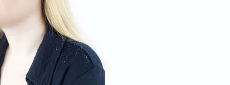Dandruff on a blond woman shoulder. Side view of a female who has more dandruff flakes on his black shirt. Scalp disease treatment concept. Discomfort from a fungal infection. head fungusの写真素材