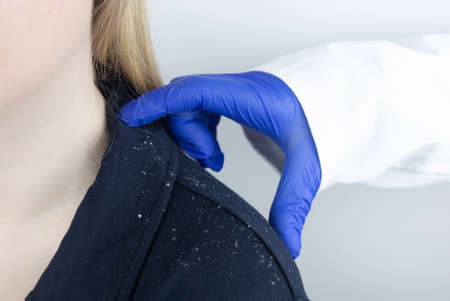 Dandruff on a blond woman shoulder. Side view of a female who has more dandruff flakes on his black shirt. Scalp disease treatment concept. Discomfort from a fungal infection. head fungusの写真素材