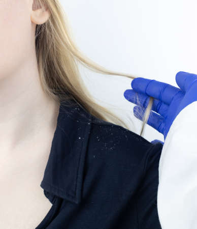 Dandruff on a blond woman shoulder. Side view of a female who has more dandruff flakes on his black shirt. Scalp disease treatment concept. Discomfort from a fungal infection. head fungusの写真素材