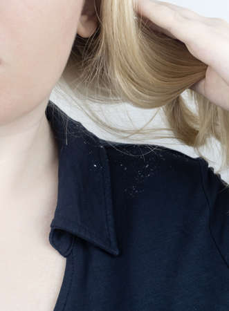 Dandruff on a blond woman shoulder. Side view of a female who has more dandruff flakes on his black shirt. Scalp disease treatment concept. Discomfort from a fungal infection. head fungusの写真素材