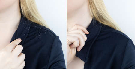 Dandruff on a blond woman shoulder. Side view of a female who has more dandruff flakes on his black shirt. Scalp disease treatment concept. Discomfort from a fungal infection. head fungusの写真素材