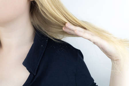 Dandruff on a blond woman shoulder. Side view of a female who has more dandruff flakes on his black shirt. Scalp disease treatment concept. Discomfort from a fungal infection. head fungusの写真素材