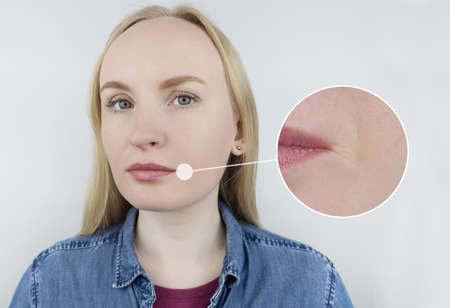 Mimic wrinkles. Rejuvenation. Lines remaining on problem areas of skin that has lost its elasticity. Wrinkles around mouth. Enlarged areas of skin where help of skin tightening specialists is requiredの写真素材