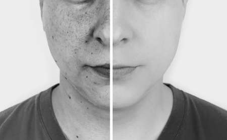 Ultraviolet rays on skin. Protective cream test. On the left, the skin is unprotected and stains...