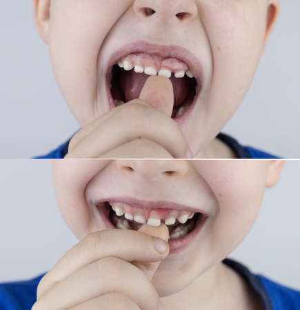before and after. Loose baby teeth. From above, the boy shows that the milk tooth is not loose. Below is a photo where a temporary tooth is looseの写真素材