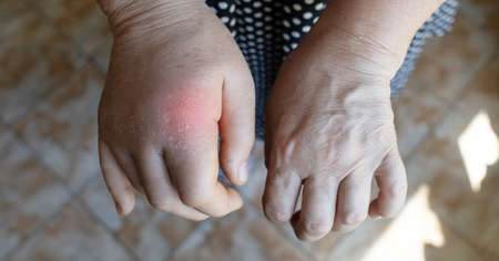 Close-up hand inflammation. Left hand was very swollen in the region of the cartilages of index finger. Inflammation of joints. Arthritis and arthritis. Swelling of adjacent tissues. brush comparisonの写真素材
