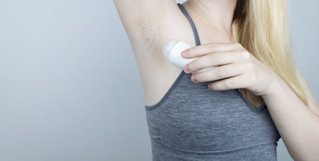 Armpit rash. Underarm skin irritation. Blonde girl shows irritation on the skin after using a razor, trimmer, deodorant or antiperspirant. Allergy or irritation. Acne or red spotsの写真素材