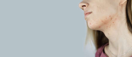 Girl shows acne on her face. acne on the neck. Demodicosis on the chin. Redness and rash on the woman face. Acne and redness treatment. Large blisters, pits and enlarged poresの写真素材