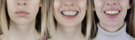 Before and after remove braces. On the left is a girl in a metal bracket system, and on the right are straight teeth after the procedure. Concept of correcting a smile and straightening teeth. close-upの写真素材