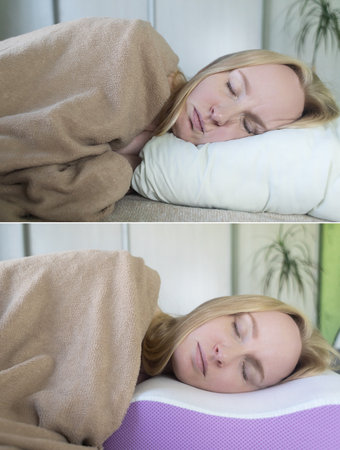before and after. On one frame, mimic folds from the wrong pillow. There are no wrinkles in the other photo, as an orthopedic pillow is used. Cosmetology and dermatologyの写真素材