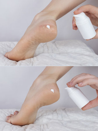 Cracked heels. Woman feet before and after procedures to soften rough skin. Urea cream, oil for care of keratinized skin, healing of cracked foot. Usage foot grater, cream with urea, softening oil.の写真素材